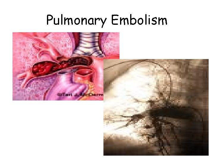 Pulmonary Embolism 