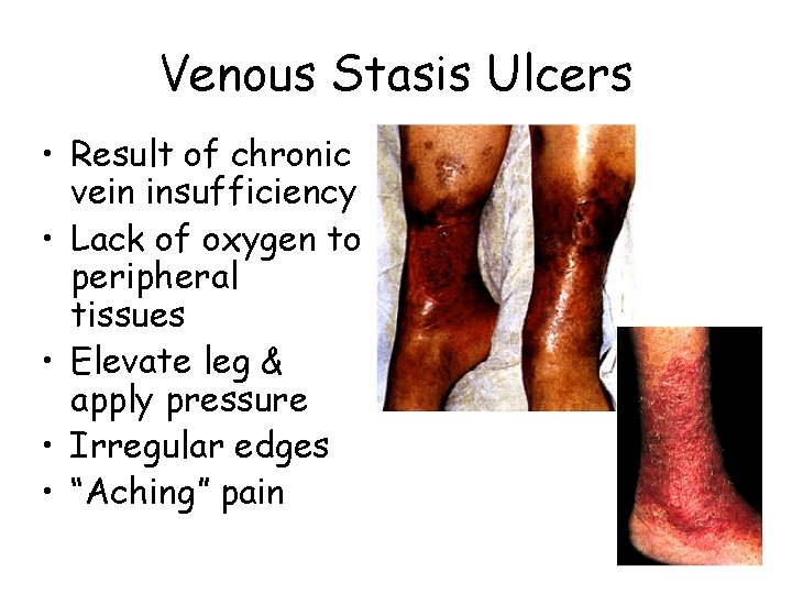 Venous Stasis Ulcers • Result of chronic vein insufficiency • Lack of oxygen to