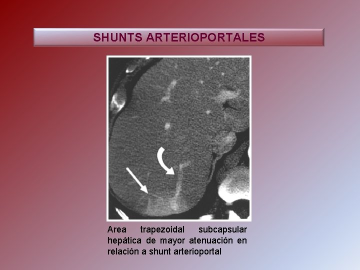 SHUNTS ARTERIOPORTALES Area trapezoidal subcapsular hepática de mayor atenuación en relación a shunt arterioportal