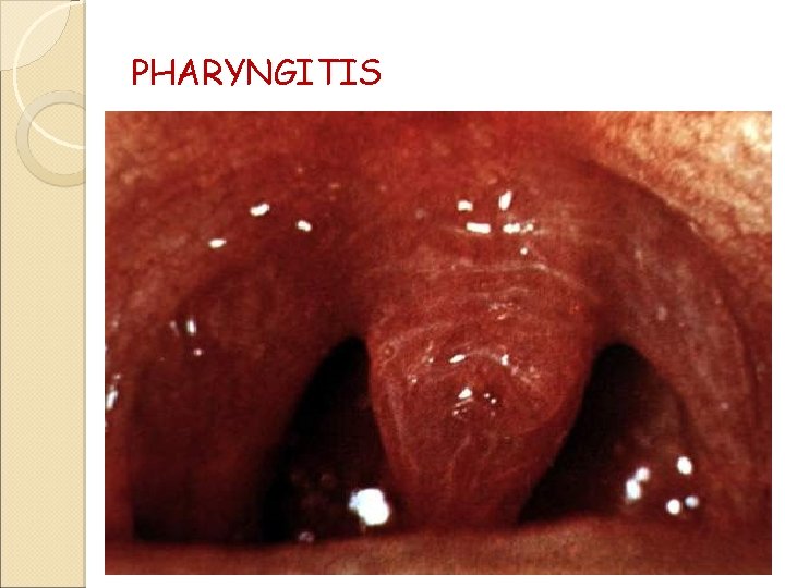 PHARYNGITIS 