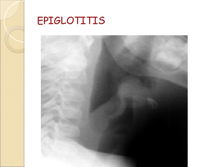 EPIGLOTITIS 