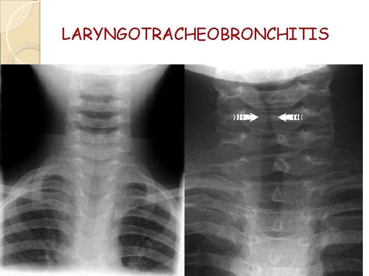 LARYNGOTRACHEOBRONCHITIS 