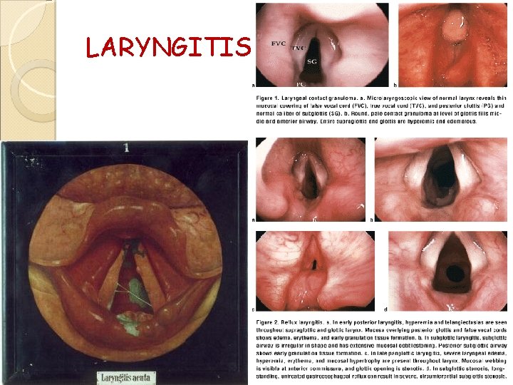 LARYNGITIS 