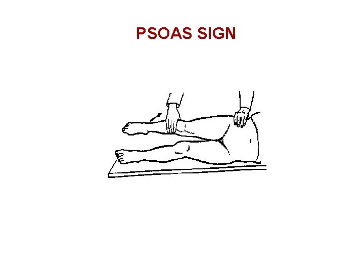 PSOAS SIGN 