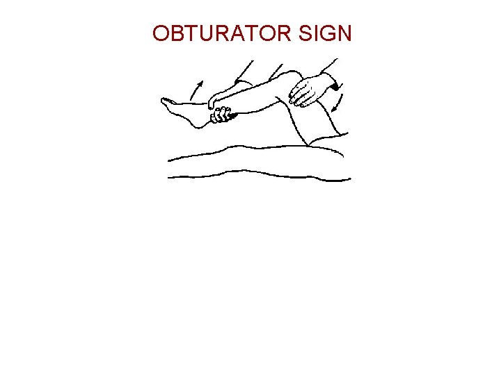 OBTURATOR SIGN 