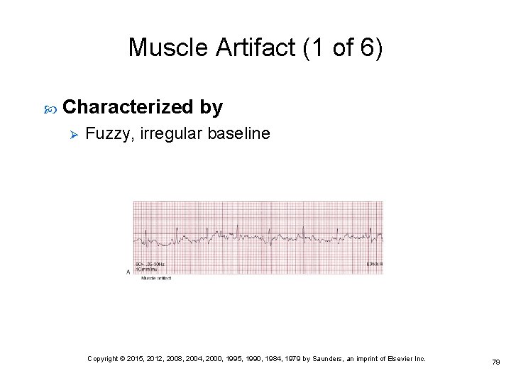 Muscle Artifact (1 of 6) Characterized by Ø Fuzzy, irregular baseline Copyright © 2015,