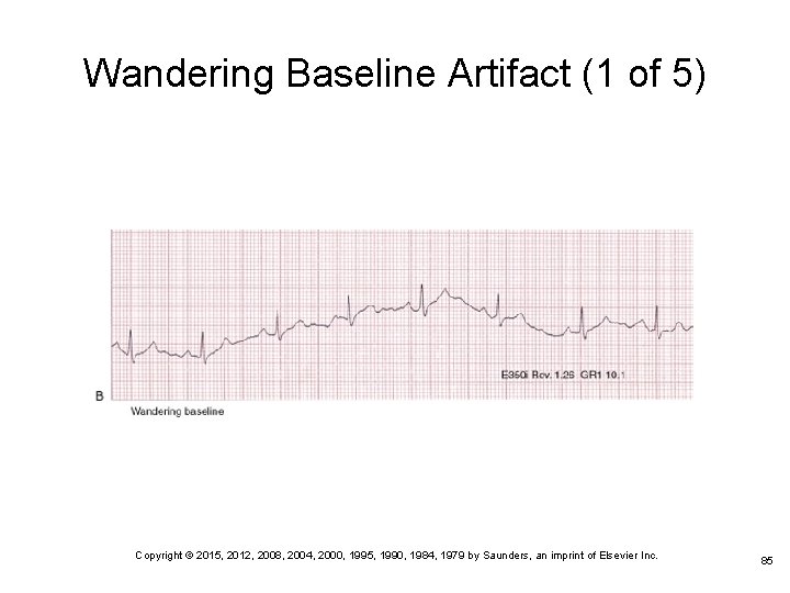 Wandering Baseline Artifact (1 of 5) Copyright © 2015, 2012, 2008, 2004, 2000, 1995,