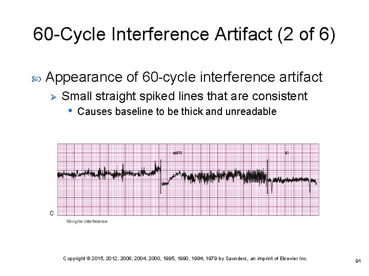 60 -Cycle Interference Artifact (2 of 6) Appearance of 60 -cycle interference artifact Ø