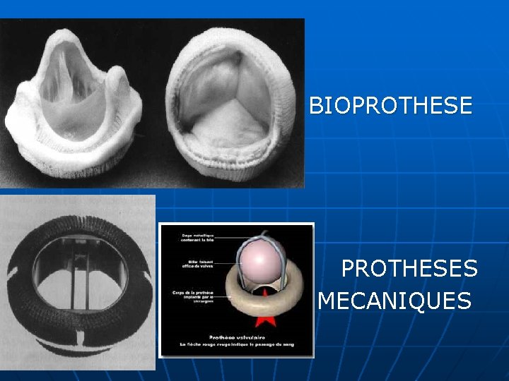 BIOPROTHESES MECANIQUES 