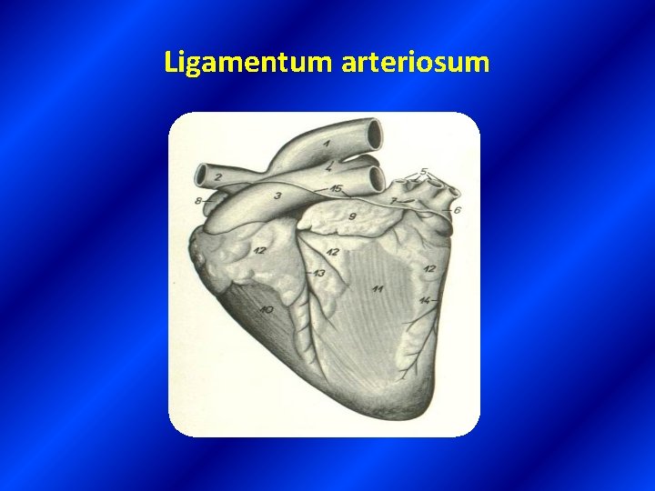 Ligamentum arteriosum 