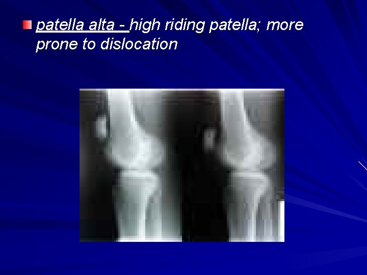 patella alta - high riding patella; more prone to dislocation 