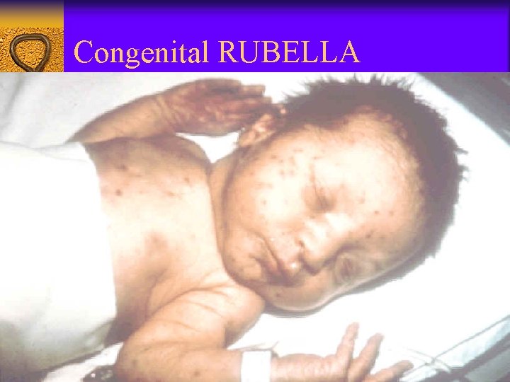 Congenital RUBELLA 