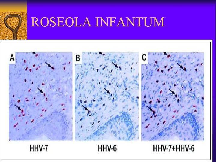 ROSEOLA INFANTUM 