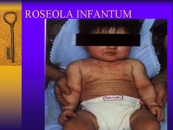 ROSEOLA INFANTUM 
