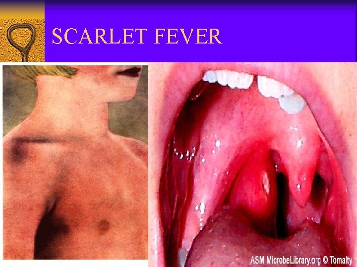 SCARLET FEVER 