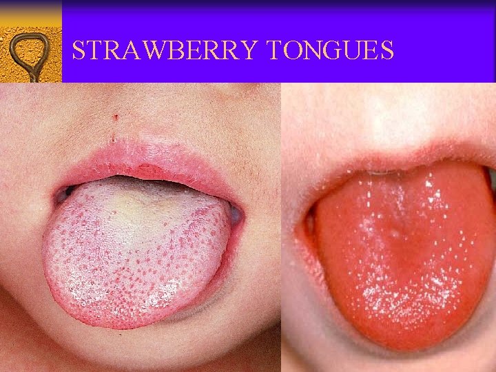 STRAWBERRY TONGUES 