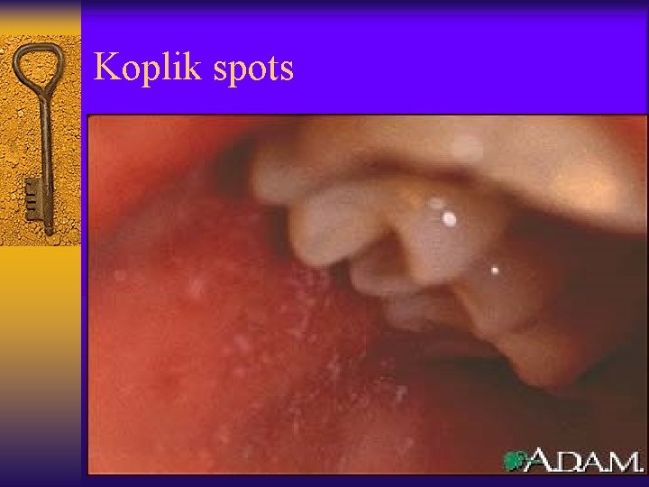 Koplik spots 