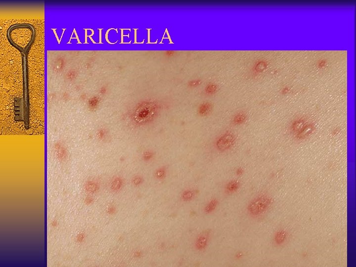 VARICELLA 