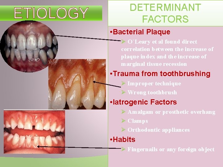 ETIOLOGY DETERMINANT FACTORS • Bacterial Plaque Ø O`Leary et al found direct correlation between