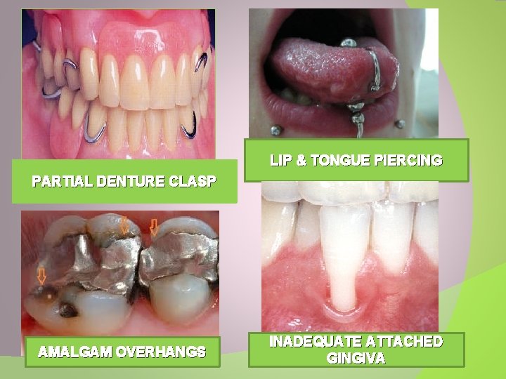 LIP & TONGUE PIERCING PARTIAL DENTURE CLASP AMALGAM OVERHANGS INADEQUATE ATTACHED GINGIVA 
