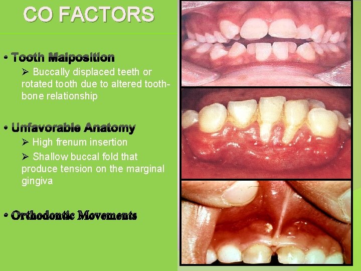 CO FACTORS • Tooth Malposition Ø Buccally displaced teeth or rotated tooth due to
