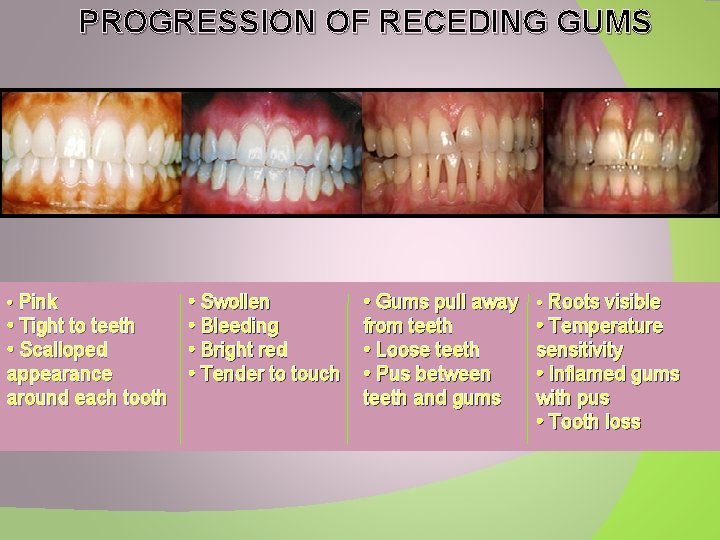 PROGRESSION OF RECEDING GUMS • Pink • Tight to teeth • Scalloped appearance around