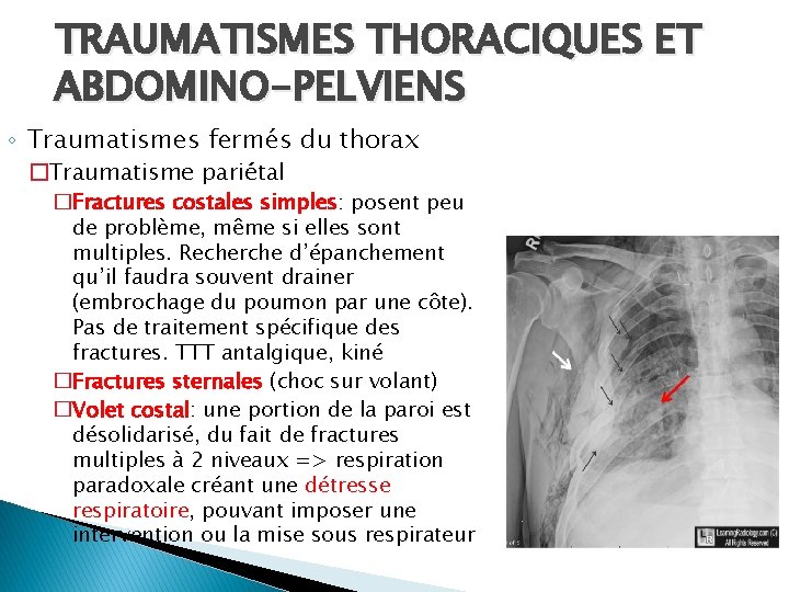 TRAUMATISMES THORACIQUES ET ABDOMINO-PELVIENS ◦ Traumatismes fermés du thorax �Traumatisme pariétal �Fractures costales simples: