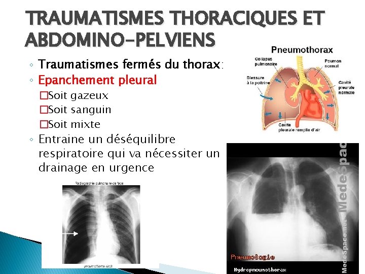 TRAUMATISMES THORACIQUES ET ABDOMINO-PELVIENS ◦ Traumatismes fermés du thorax: ◦ Epanchement pleural �Soit gazeux