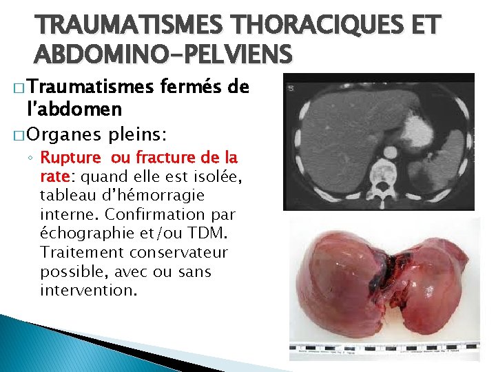 TRAUMATISMES THORACIQUES ET ABDOMINO-PELVIENS � Traumatismes fermés de l’abdomen � Organes pleins: ◦ Rupture