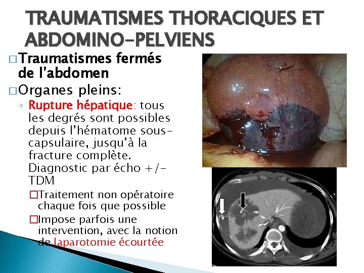 TRAUMATISMES THORACIQUES ET ABDOMINO-PELVIENS � Traumatismes fermés de l’abdomen � Organes pleins: ◦ Rupture