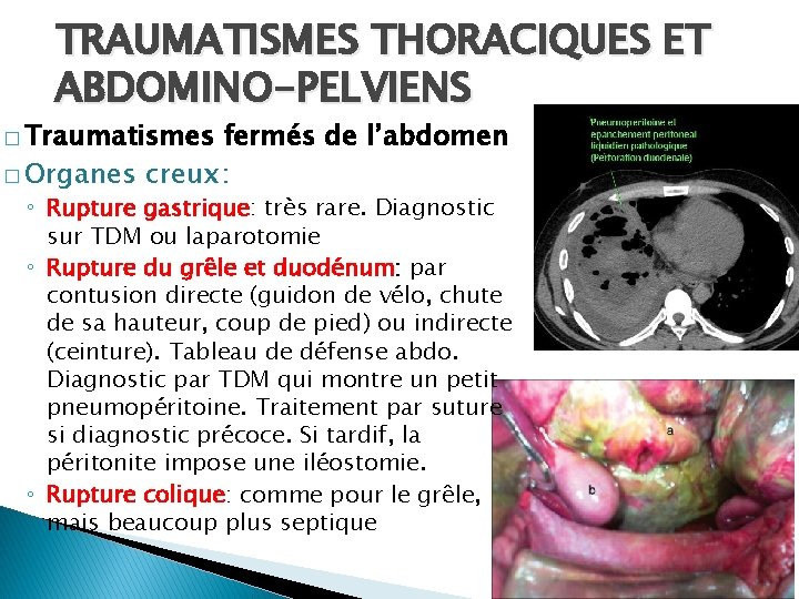 TRAUMATISMES THORACIQUES ET ABDOMINO-PELVIENS � Traumatismes fermés de l’abdomen � Organes creux: ◦ Rupture