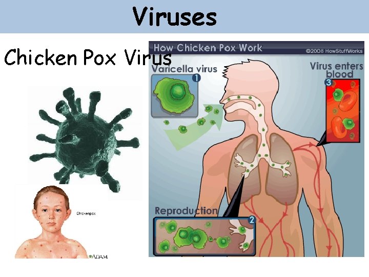 Viruses Chicken Pox Virus 