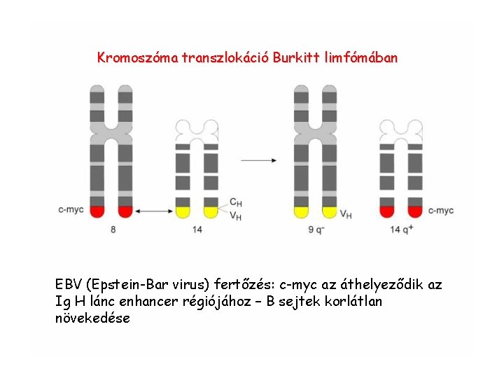 Kromoszóma transzlokáció Burkitt limfómában EBV (Epstein-Bar virus) fertőzés: c-myc az áthelyeződik az Ig H