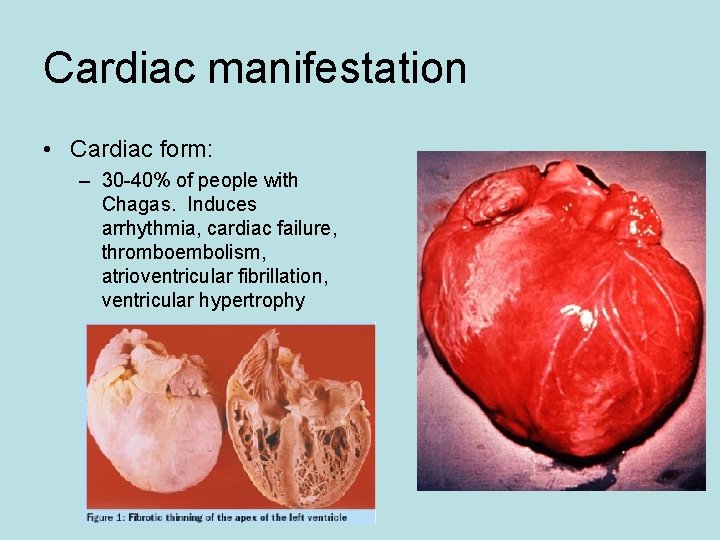 Cardiac manifestation • Cardiac form: – 30 -40% of people with Chagas. Induces arrhythmia, Cardiac manifestation • Cardiac form: – 30 -40% of people with Chagas. Induces arrhythmia,
