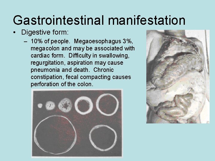 Gastrointestinal manifestation • Digestive form: – 10% of people. Megaoesophagus 3%, megacolon and may Gastrointestinal manifestation • Digestive form: – 10% of people. Megaoesophagus 3%, megacolon and may
