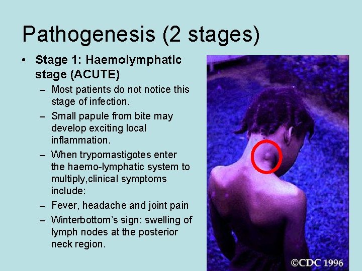 Pathogenesis (2 stages) • Stage 1: Haemolymphatic stage (ACUTE) – Most patients do notice Pathogenesis (2 stages) • Stage 1: Haemolymphatic stage (ACUTE) – Most patients do notice