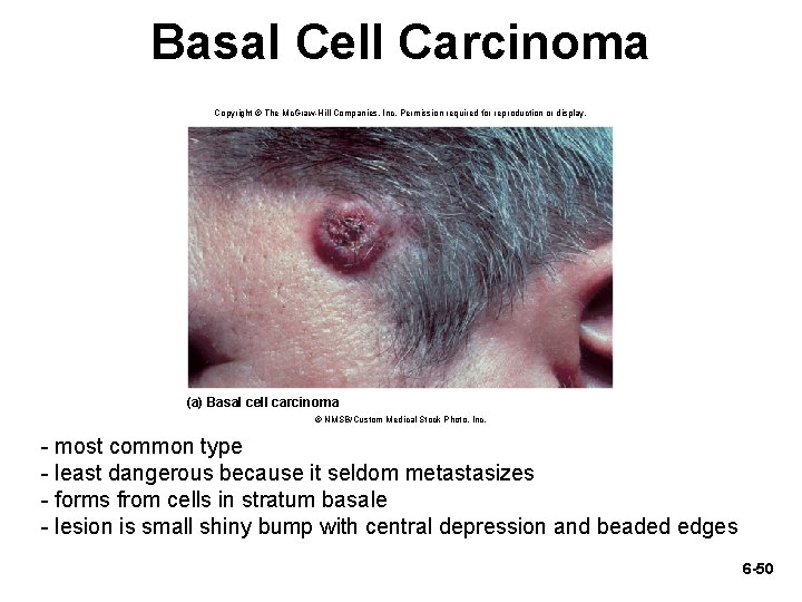 Basal Cell Carcinoma Copyright © The Mc. Graw-Hill Companies, Inc. Permission required for reproduction