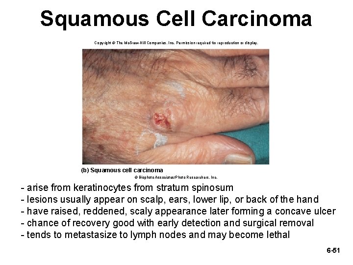 Squamous Cell Carcinoma Copyright © The Mc. Graw-Hill Companies, Inc. Permission required for reproduction