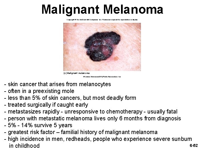Malignant Melanoma Copyright © The Mc. Graw-Hill Companies, Inc. Permission required for reproduction or
