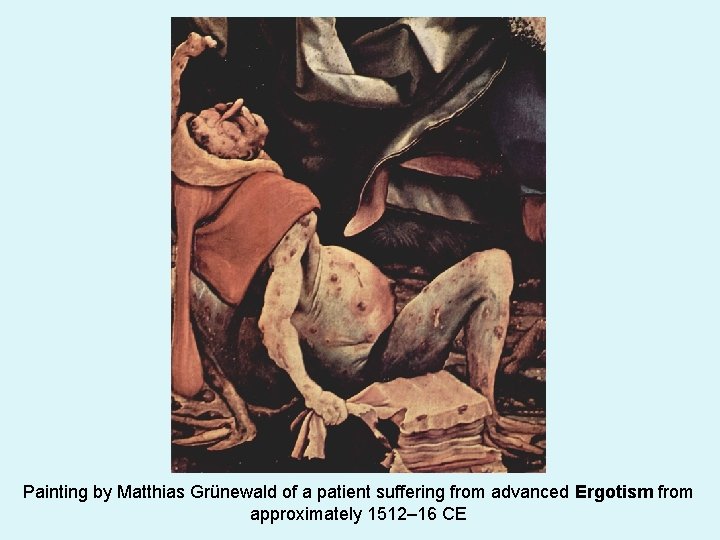 Painting by Matthias Grünewald of a patient suffering from advanced Ergotism from approximately 1512–
