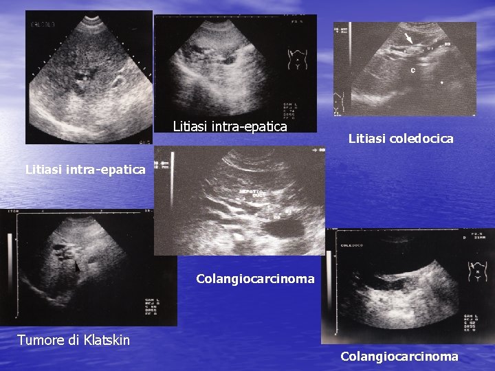 Litiasi intra-epatica Litiasi coledocica Litiasi intra-epatica Colangiocarcinoma Tumore di Klatskin Colangiocarcinoma 