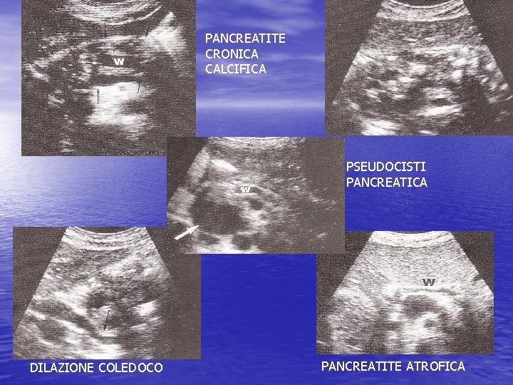 PANCREATITE CRONICA CALCIFICA PSEUDOCISTI PANCREATICA DILAZIONE COLEDOCO PANCREATITE ATROFICA 