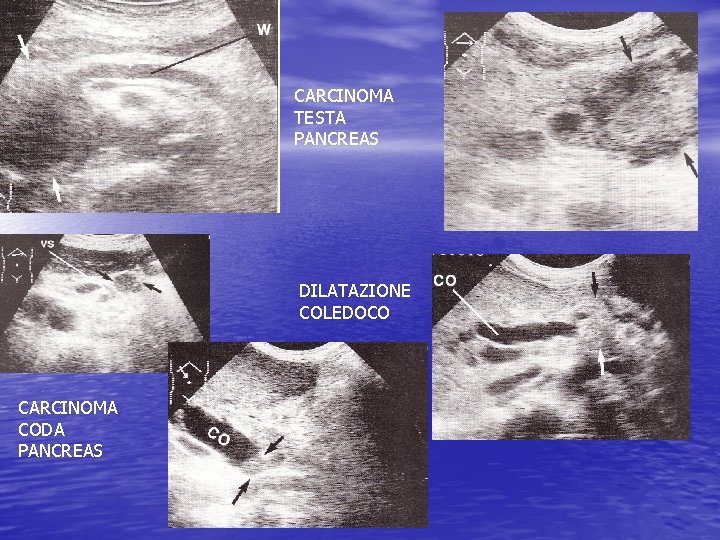 CARCINOMA TESTA PANCREAS DILATAZIONE COLEDOCO CARCINOMA CODA PANCREAS 