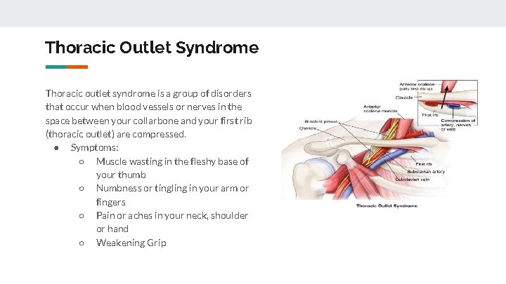 Thoracic Outlet Syndrome Thoracic outlet syndrome is a group of disorders that occur when