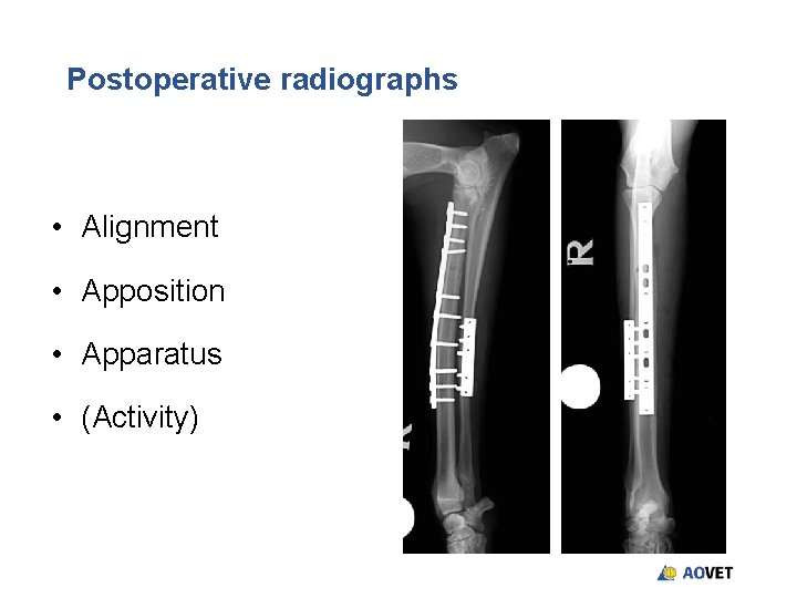 Postoperative radiographs • Alignment • Apposition • Apparatus • (Activity) Postoperative radiographs • Alignment • Apposition • Apparatus • (Activity)