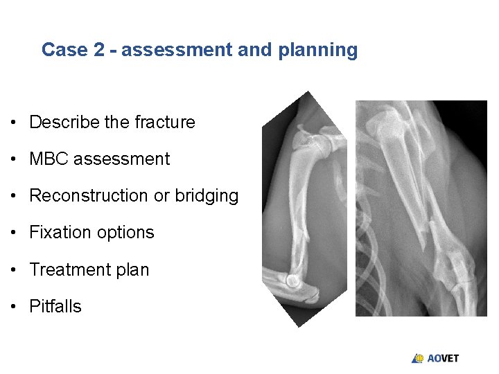 Case 2 - assessment and planning • Describe the fracture • MBC assessment • Case 2 - assessment and planning • Describe the fracture • MBC assessment •