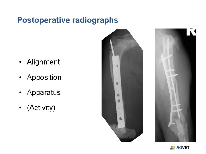 Postoperative radiographs • Alignment • Apposition • Apparatus • (Activity) Postoperative radiographs • Alignment • Apposition • Apparatus • (Activity)