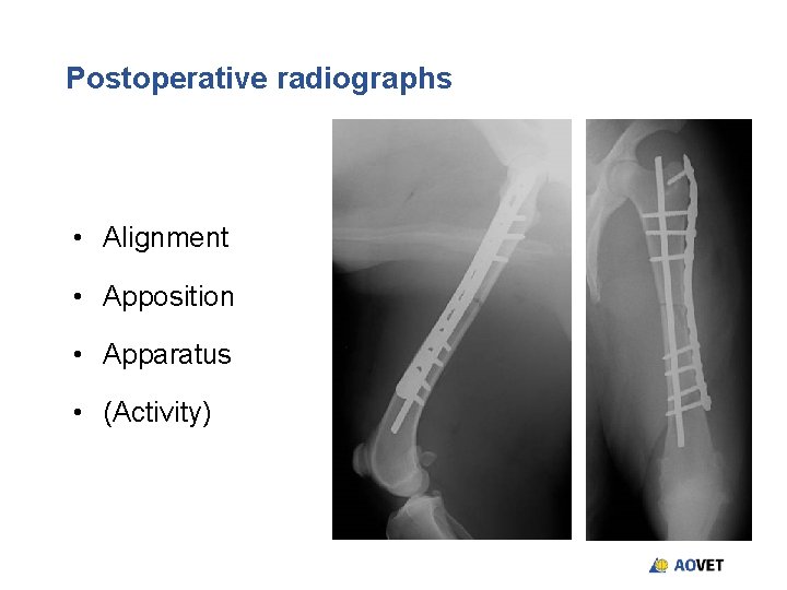 Postoperative radiographs • Alignment • Apposition • Apparatus • (Activity) Postoperative radiographs • Alignment • Apposition • Apparatus • (Activity)
