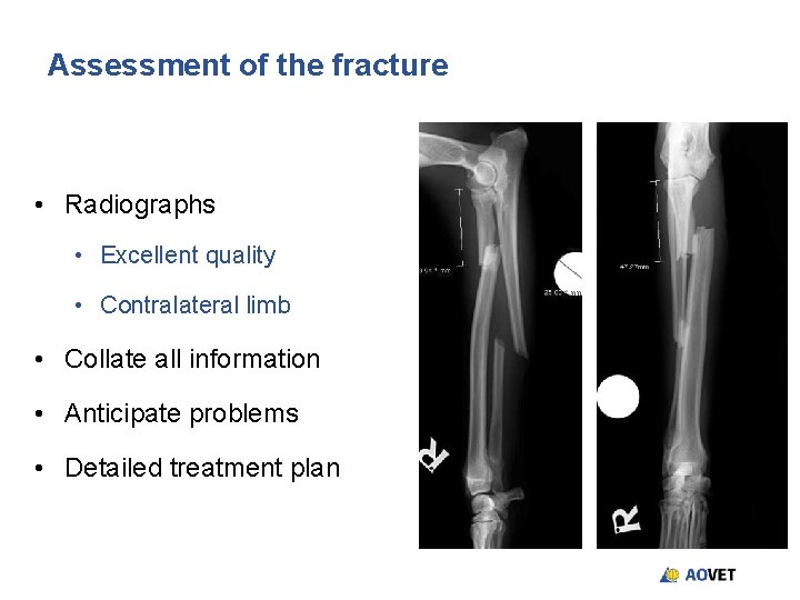 Assessment of the fracture • Radiographs • Excellent quality • Contralateral limb • Collate Assessment of the fracture • Radiographs • Excellent quality • Contralateral limb • Collate
