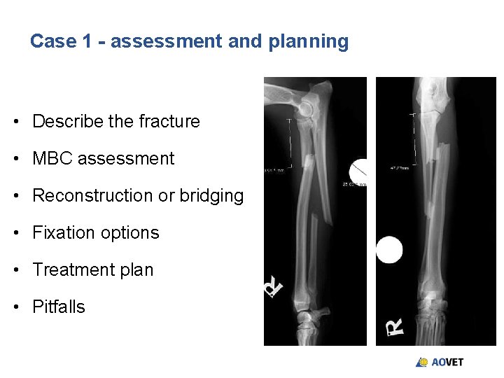 Case 1 - assessment and planning • Describe the fracture • MBC assessment • Case 1 - assessment and planning • Describe the fracture • MBC assessment •